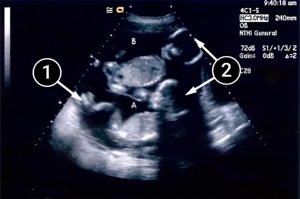 El desarrollo fetal de tu bebé llega a su primera meta