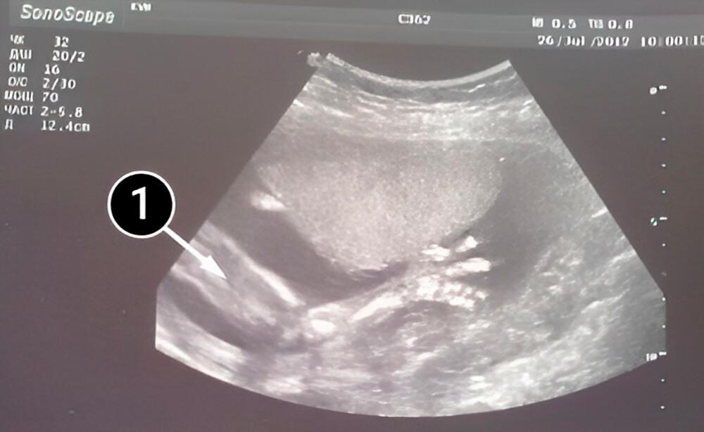 Puedes escuchar los latidos del corazón del bebé tú mismo