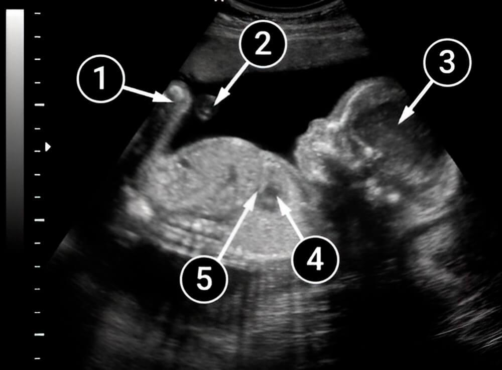 El bebé está cubierto de pelo fino