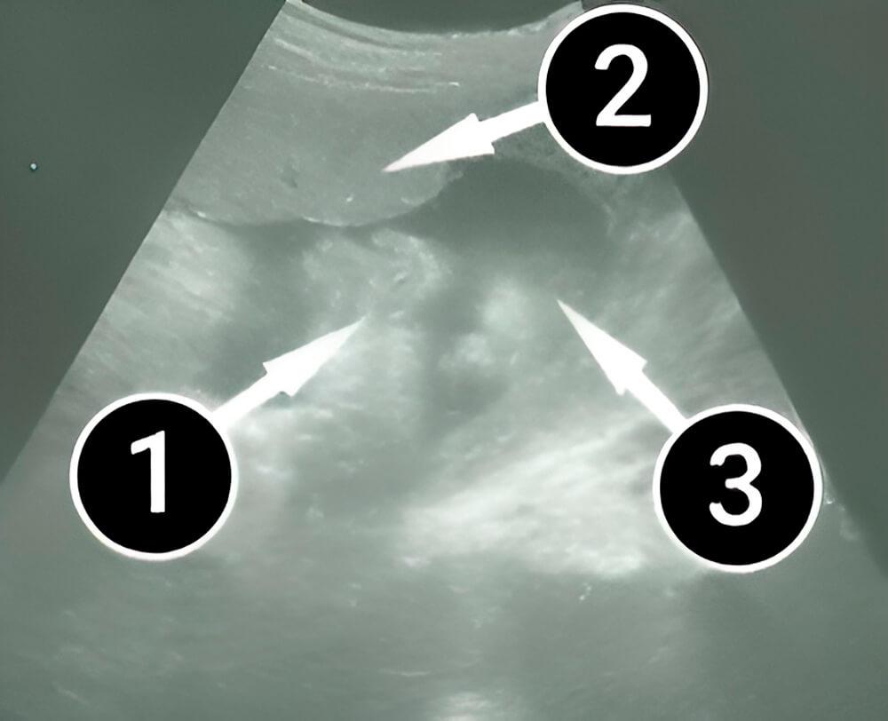 El bebé se coloca con la cabeza hacia abajo