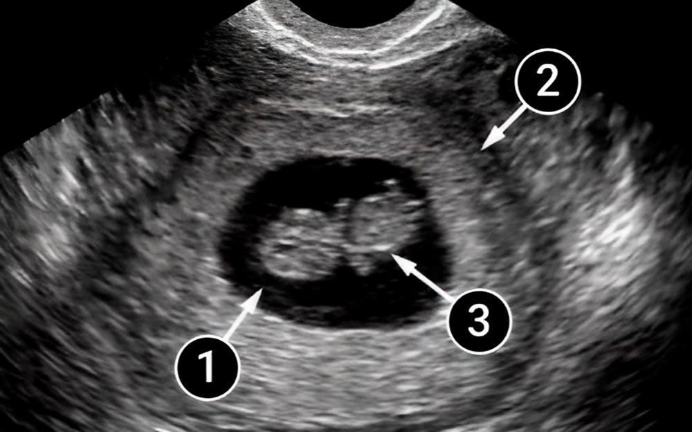 El bebé está bien protegido
