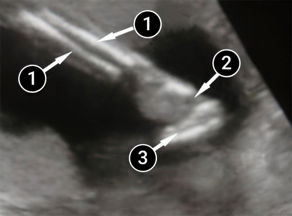 El bebé está ganando peso rápidamente