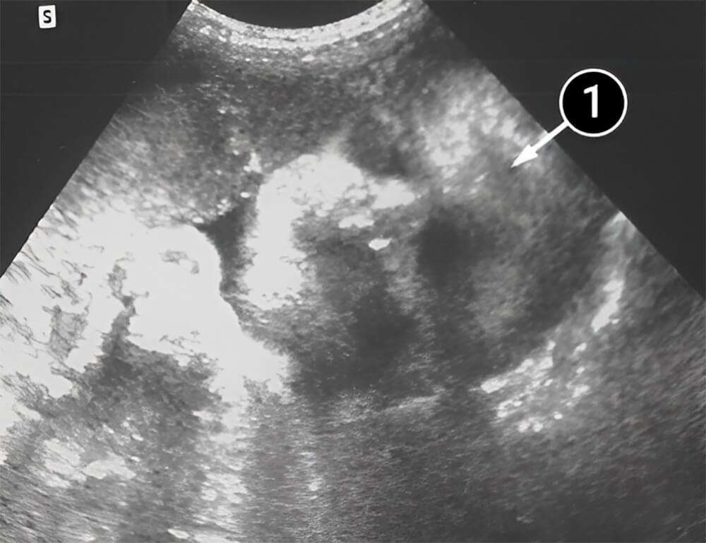 El bebé ya podría sobrevivir fuera del útero