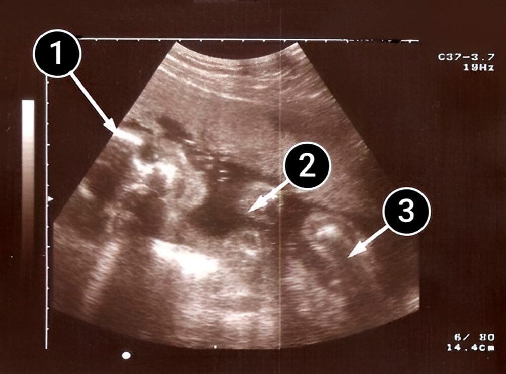 El bebé se asemeja más a un recién nacido