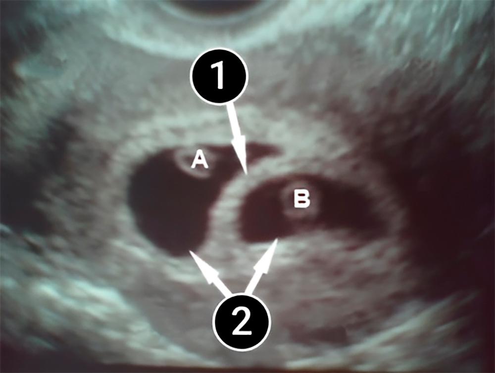 Puedes escuchar el corazón del bebé