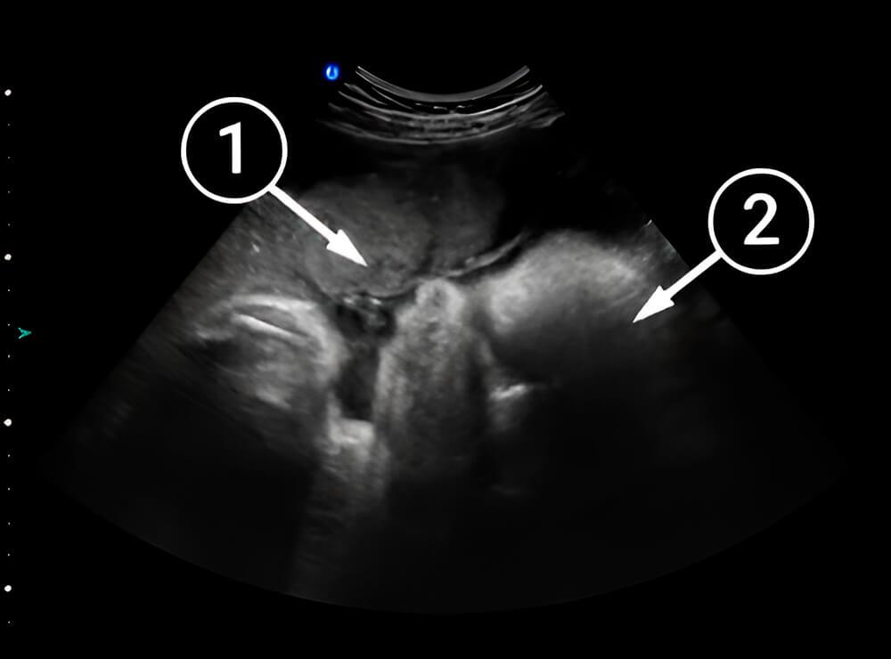 ¡El bebé está listo para nacer!