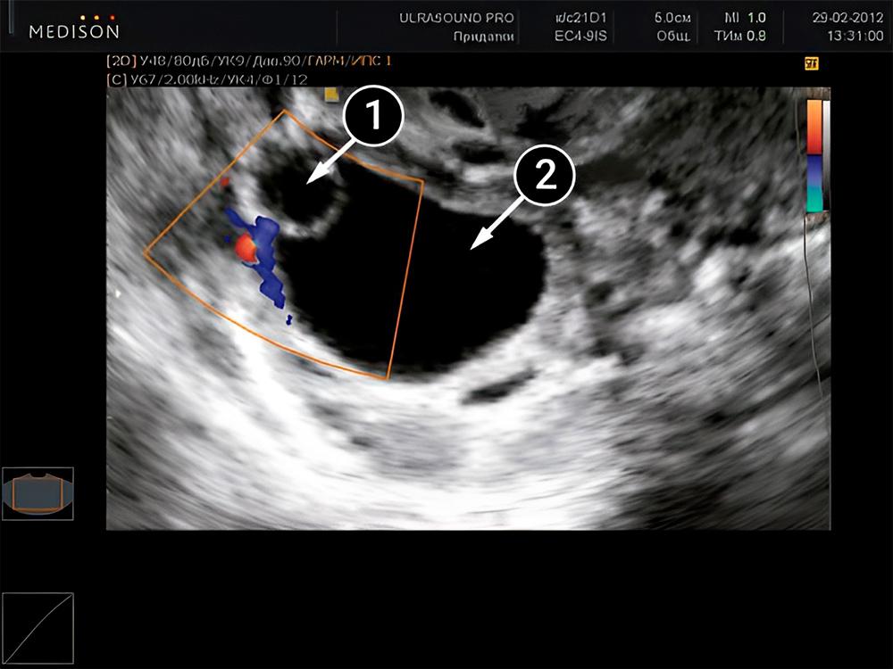 ¿Cuándo comienza el embarazo?