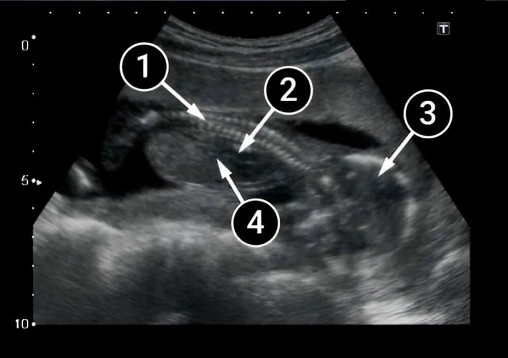 ¡El sexo del bebé ya es visible!