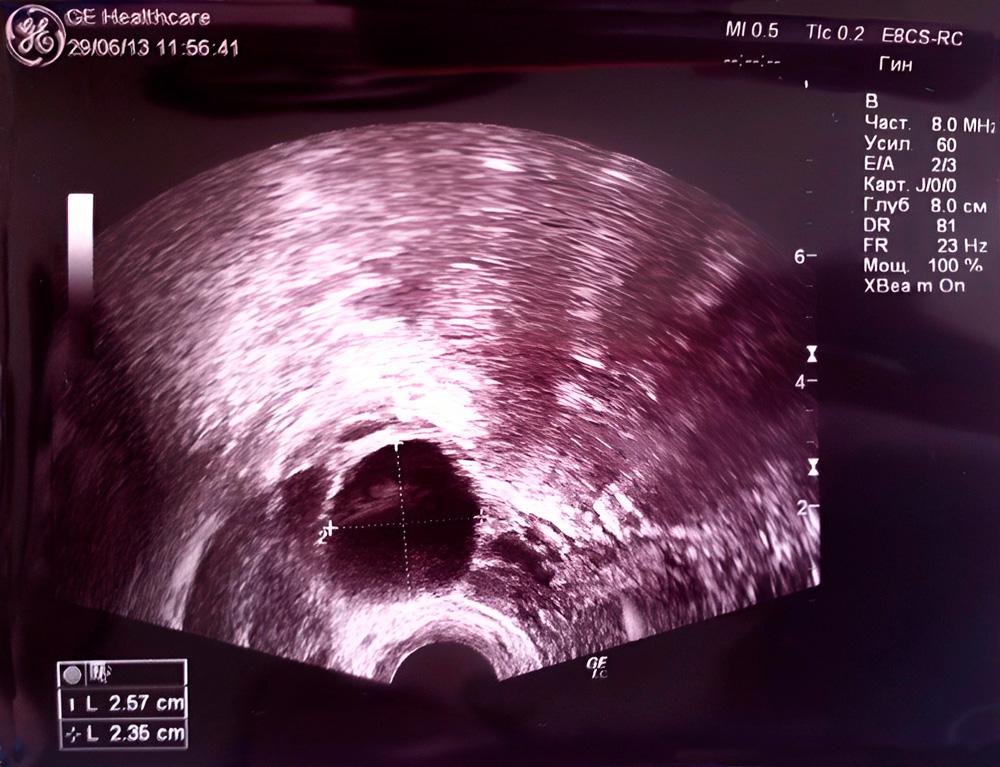 ¿Cuándo comienza el embarazo?